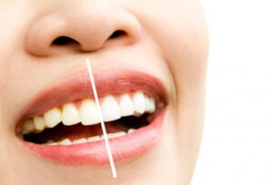 Before and after smile makeover in Surat