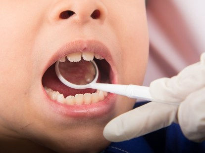 Child-Friendly Dental Services in Surat