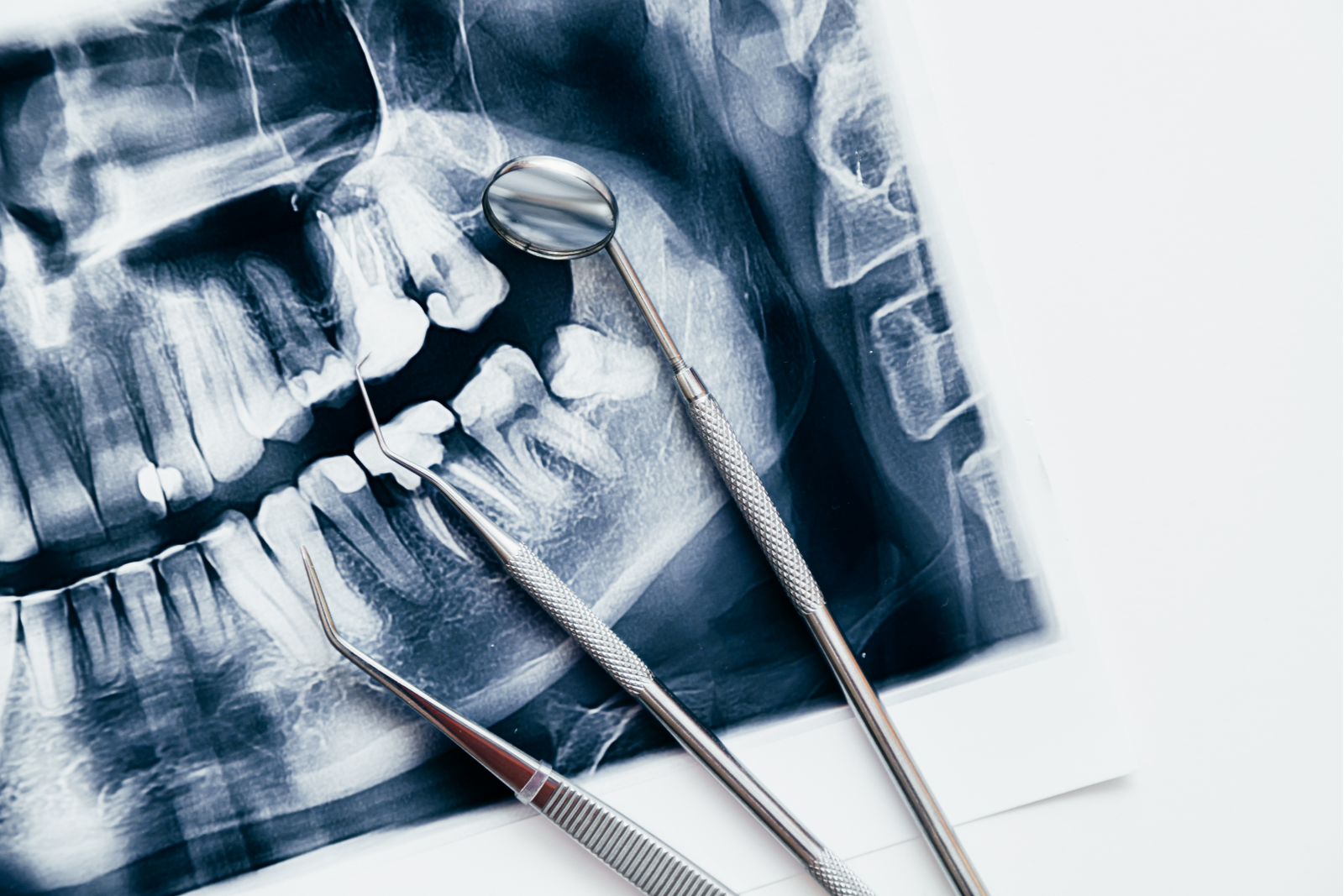 Full Mouth Rehabilitation in Surat