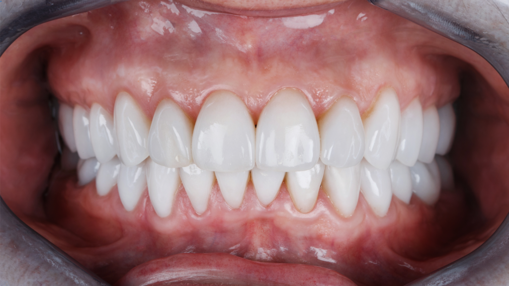 Veneers Services in Cuspid Dental clinic in surat