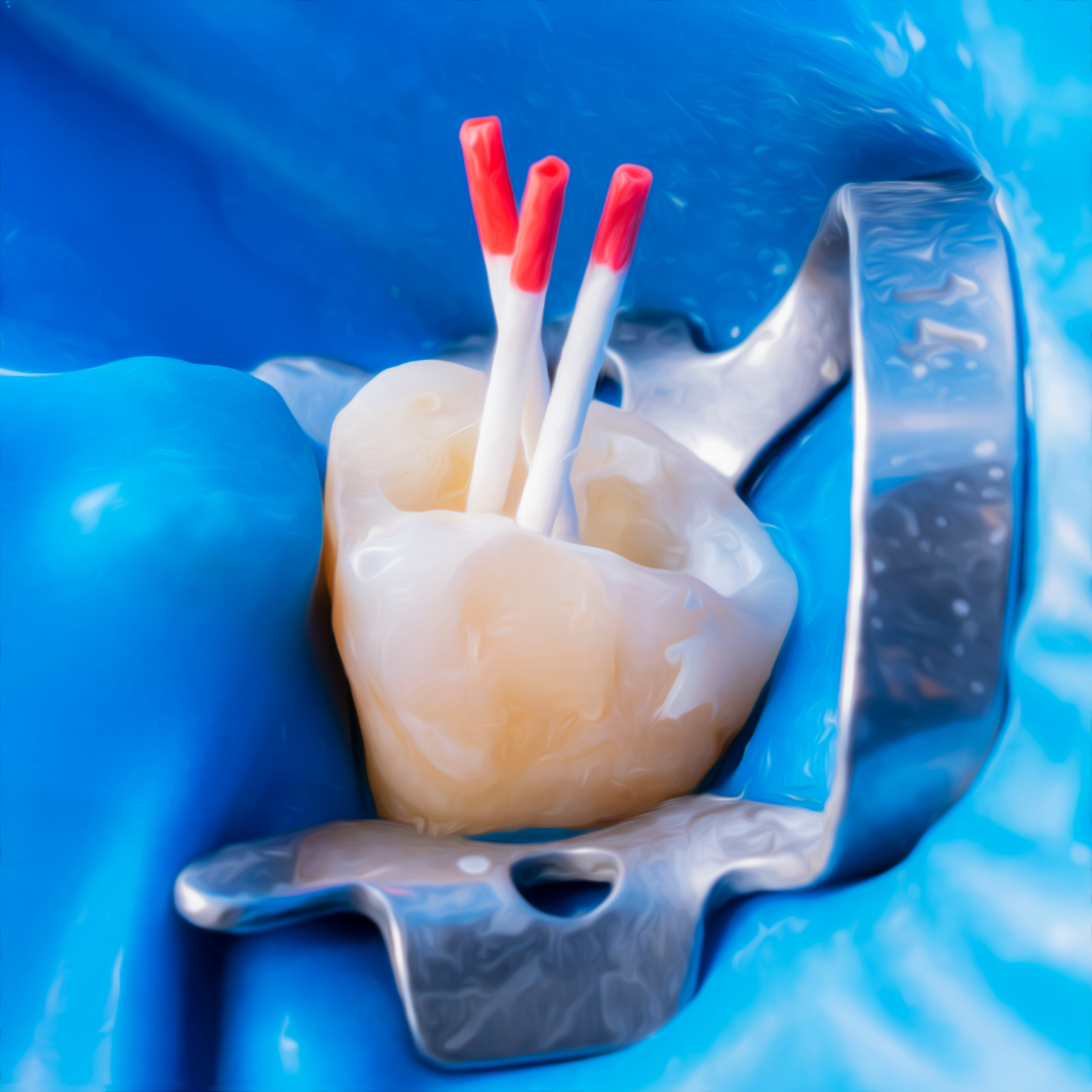 Pain-Free Endodontic Services in Surat