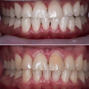 Teeth Whitening Services in Cuspid Dental clinic in surat