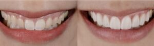 Veneers Services in Cuspid Dental clinic in surat