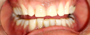 Worn and misaligned teeth commonly seen in patients needing full mouth rehabilitation
