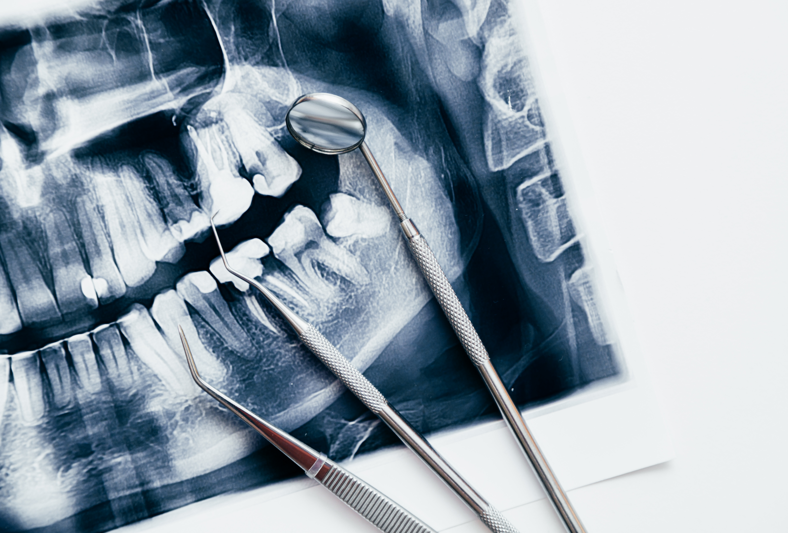 Full mouth rehabilitation assessment using dental imaging in Surat