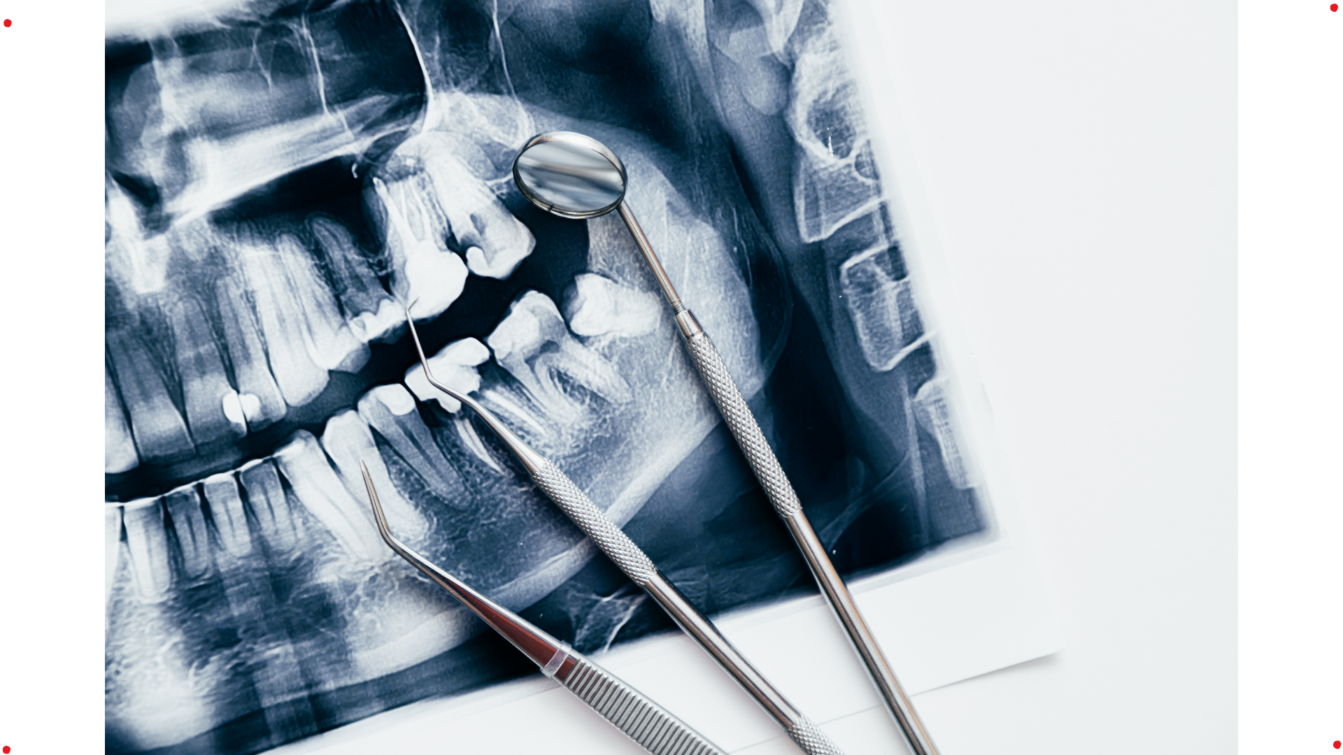 Full mouth rehabilitation assessment using dental imaging in Surat