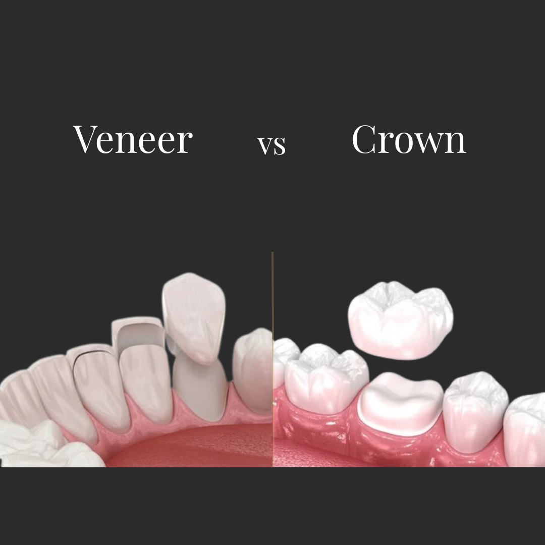 Comparison of veneer and crown restorations showing differences in tooth coverage and preparation